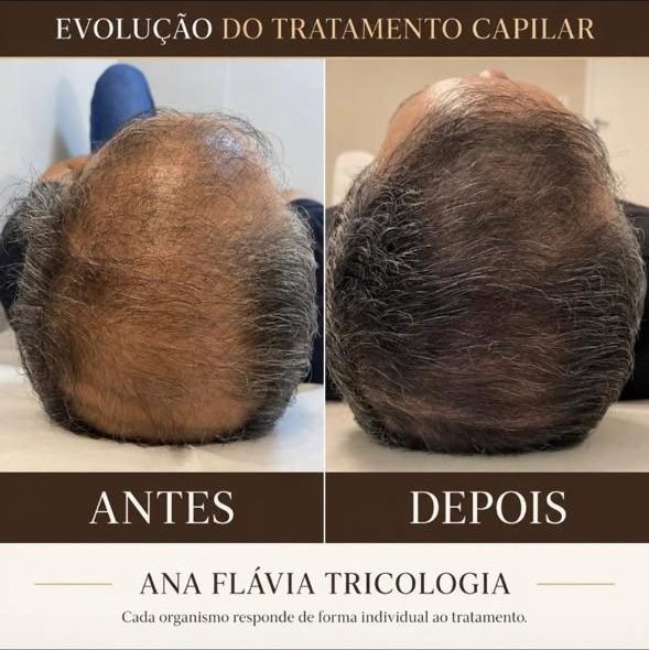 Antes e depois do tratamento capilar de um paciente: couro cabeludo com falhas à esquerda e com maior densidade à direita